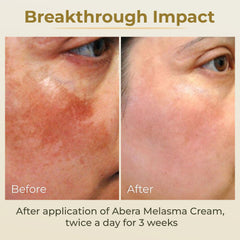 ABERA Melasma Cream — application corps sur bras et jambes.