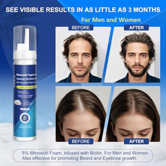 AOOLCF Minoxidil : convient à hommes et femmes pour une densité potentielle