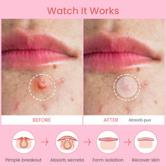 Patch AUSLKA anti-boutons visage 12 mm, adapté aux imperfections plus grandes.