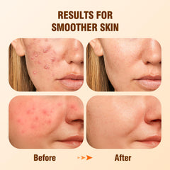BIYSBER Sérum acide salicylique 2% – goutte-doseuse, contrôle l’excès de sébum.