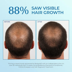 BosleyMD Minoxidil, solution topique de 60 ml promettant une pousse potentielle.