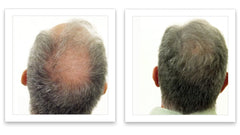 Caboki application sur cheveux clairsemés pour rendu dense.