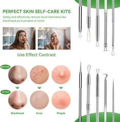 ChenYiJin outils comedons anti-allergiques; adaptés à tous les types de peau.