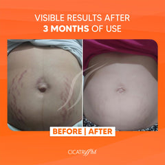 Cicatrissim: réduction des taches visibles pour une peau plus lisse.