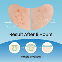 Patch hydrocolloïde DERMA ANGEL sur front, traitement discret des imperfections.