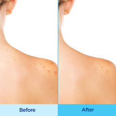 Differin Spray Corps présente 3% d’acide glycolique pour exfolier en douceur.