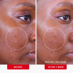 First Aid Beauty Acne Pads visage, format pratique pour soin quotidien.