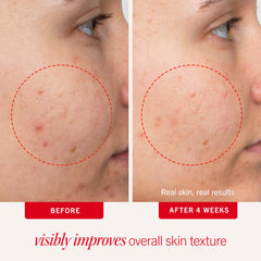First Aid Beauty Acne Pads visage, acide salicylique 2% pour pores plus propres.