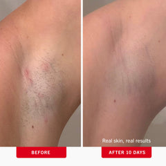 Tampon First Aid Beauty ligne bikini, réduction des irritations post-rasage.