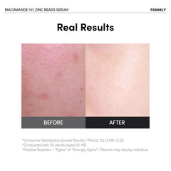 Perles encapsulées de zinc libérant le niacinamide pour une efficacité ciblée.