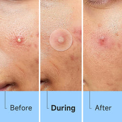 Glowpatch hydrocolloide-100pourcent : formule douce adaptée à tous types de peau