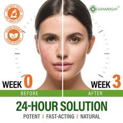 GRAMRIGHT Crème Acné, application visage, texture légère et hydratante.