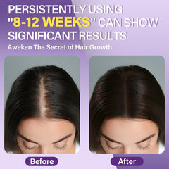 Greoay Mousse Minoxidil 5% — applicateur pour une application précise