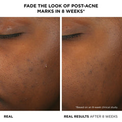 IT Cosmetics Bye Bye Breakout Serum réduction visible des boutons après application.