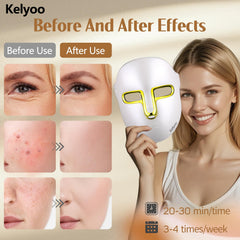 Le masque LED Kelyoo visage bleu ciblant les imperfections pour un teint plus uniforme.