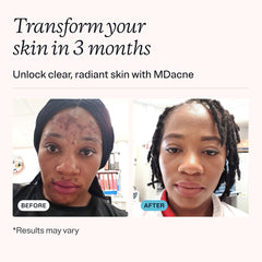 Texture crème retinol MDacne sur peau pour application douce.