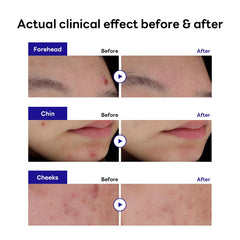 Barrière protectrice Mediheal Derma Clear sur peau irritée.