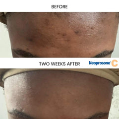 Neoprosone sérum vitamine C, alpha arbutin, améliore l'uniformité du teint.
