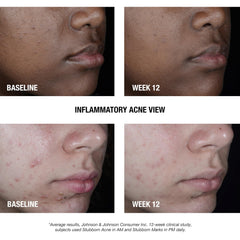Neutrogena Stubborn Acne AM Treatment packaging box