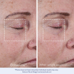Obagi ELASTIderm Concentré Avancé – avant/après montrant une réduction visuelle des ridules.