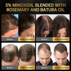 OCSINL Minoxidil embout massage racines, stimulation douce du cuir chevelu.