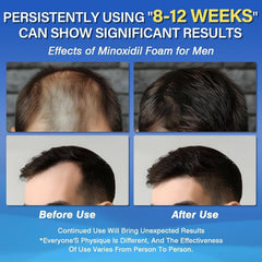 Texture crèmeuse de la mousse Olassubd Minoxidil pour application douce