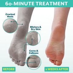 Patchology PoshPeel Pedi Cure – exfoliation-progressive qui révèle une peau plus douce.