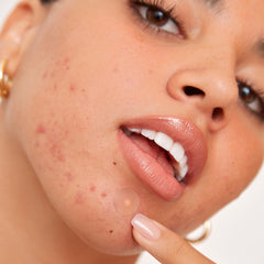 Peace Out Acne Healing Dots packaging shown in a 20-count box