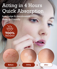 Pimple Lab pansement-hydrocolloide-absorption: absorbe l’excès de fluide