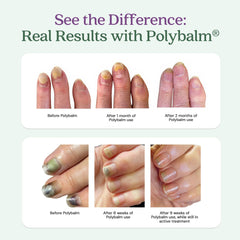 Application du baume Polybalm sur les doigts pour le confort des ongles.