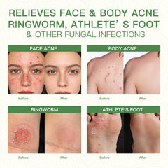 QualiLife Tea Tree Soap soothing relief for itching and redness on skin.