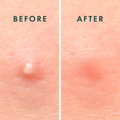 Rael hydrocolloid patch applied to acne for overnight care.