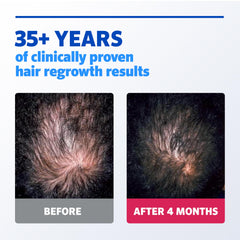 Rogaine 5% Minoxidil – zone vertex et ciblage de l’affinement naissant.