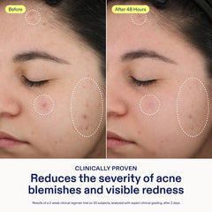 Skinfix 2% BHA Spot Treatment – application ciblée sur une zone.