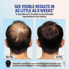TARO Minoxidil flacon-aérosol : solution pratique prête à l’emploi.