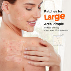 Patch hydrocolloïde TKTK point 8 mm pour petites imperfections