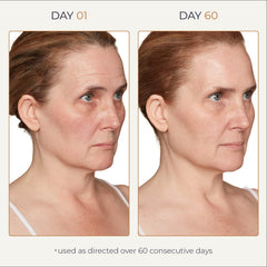 Spot Check sur zones d'hyperpigmentation visibles, amélioration potentielle.