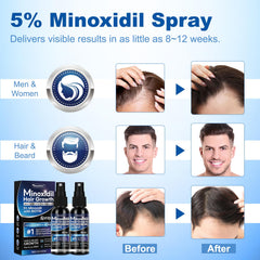 Zone capillaire clairsemée avec Tuymec Minoxidil 5% peut aider à densifier.