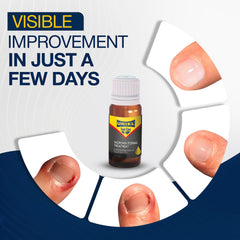 URIEL UPGRADED – Gouttes naturelles pour l'ongle incarné, application simple.