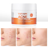 YAFUSIPE Soin acne visage: visage clair et zones ciblées.