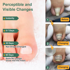 Yanxifei outils-traitement-ongle-incarné, ensemble pour entretenir l’ongle en simplicité.