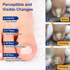 Yanxifei Kit traitement à domicile pour ongle incarné, tout-en-un