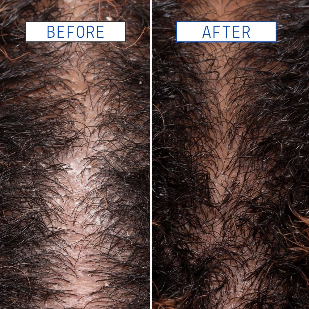 AAVRANI Acide Glycolique Exfoliation: exfolie en douceur le cuir chevelu.