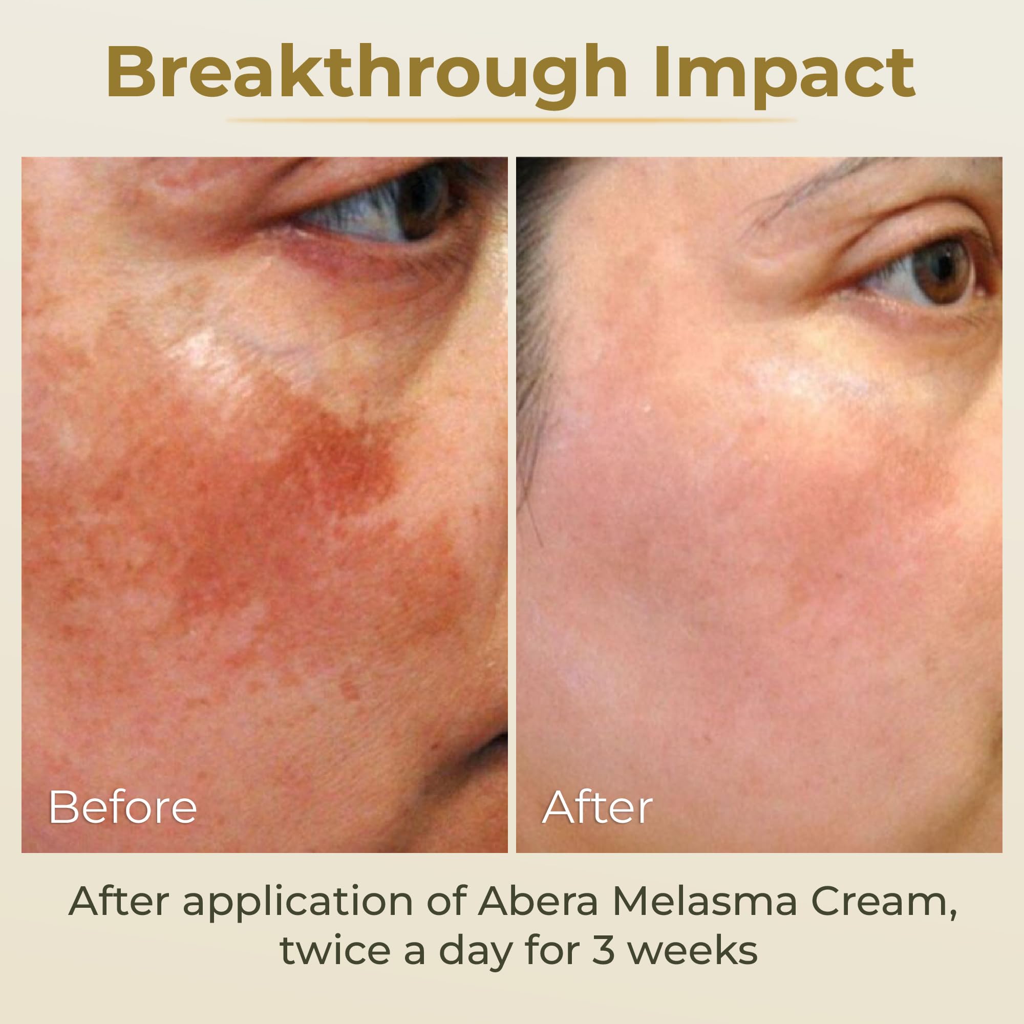 ABERA Melasma Cream — application corps sur bras et jambes.