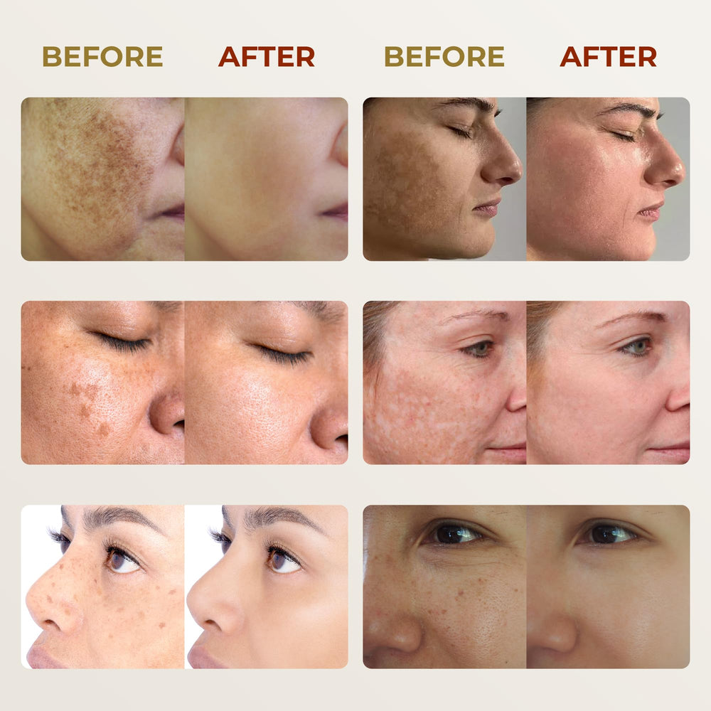 ABERA Melasma Cream — hydratation intense pour peau douce.