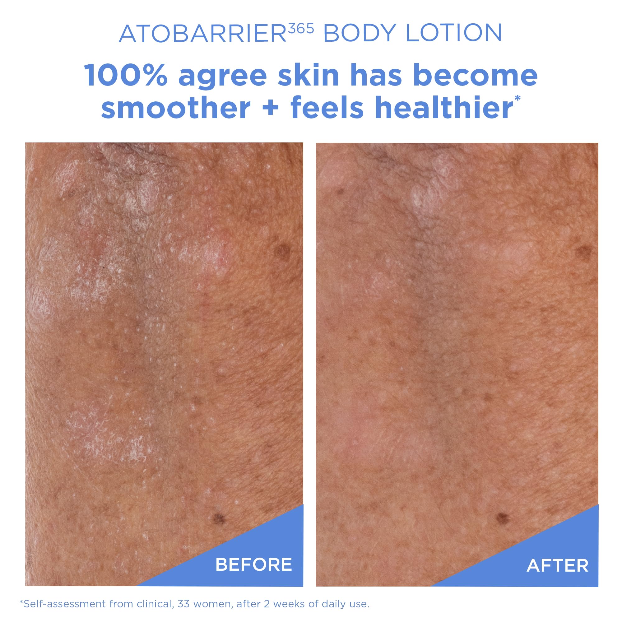 Exfoliation douce au PHA: peau plus lisse sans irritations.