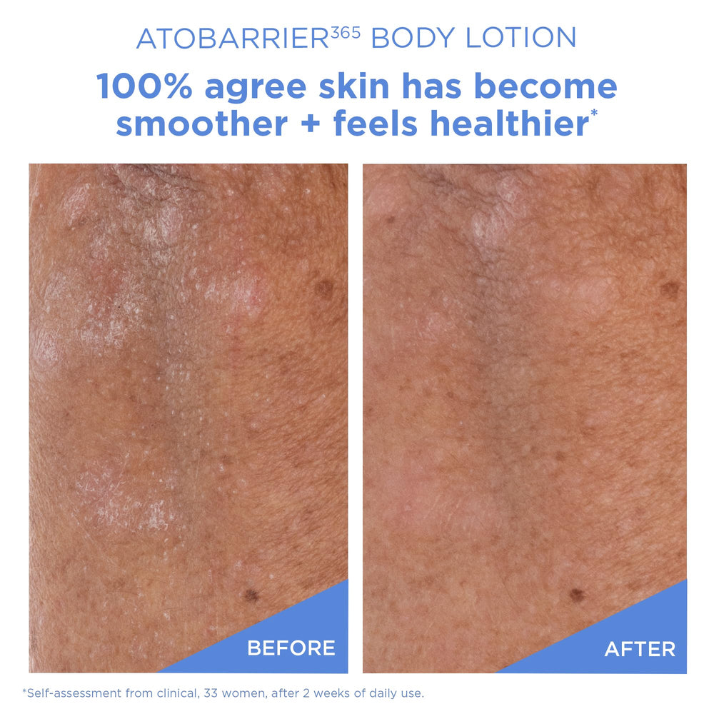 Exfoliation douce au PHA: peau plus lisse sans irritations.