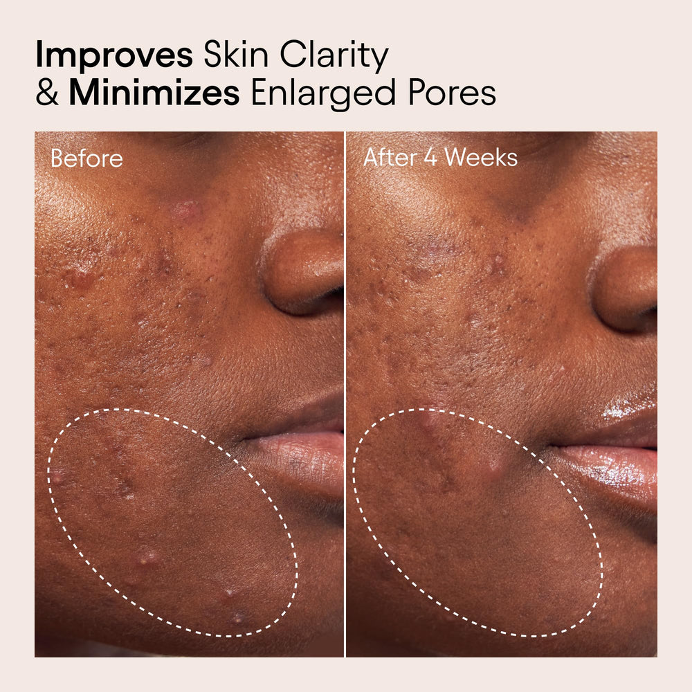 Alpyn Beauty tonique bha 2 pourcent: exfoliation en douceur des impuretés