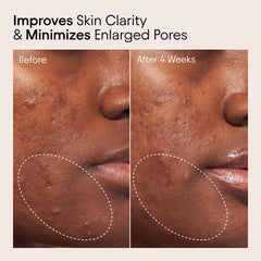 Alpyn Beauty tonique bha 2 pourcent: exfoliation en douceur des impuretés