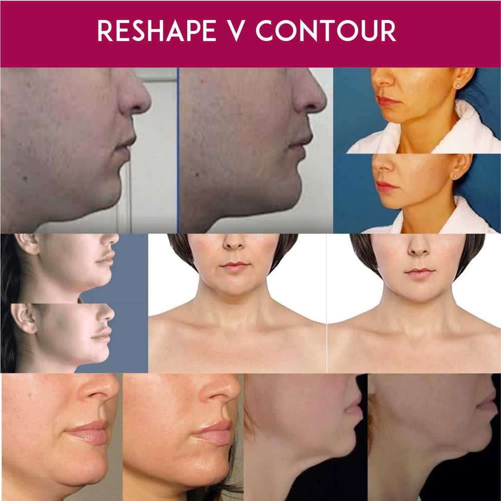 Anacis Crème Cou contouring menton et mâchoire défini